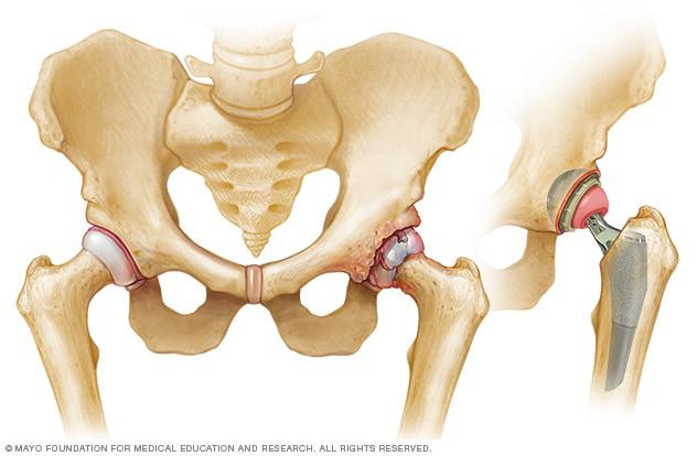 Hip Replacement Surgery Risks & Hip Surgery Options - Skeletal Hip Surgery Before & After Illustration