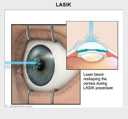 Lasik Story - Laser Beam Reshaping the Cornea During LASIK Procedure Illustration