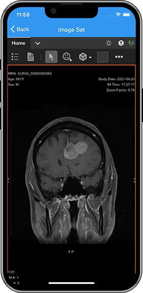 SurgiConnect app screen mri scan of brain